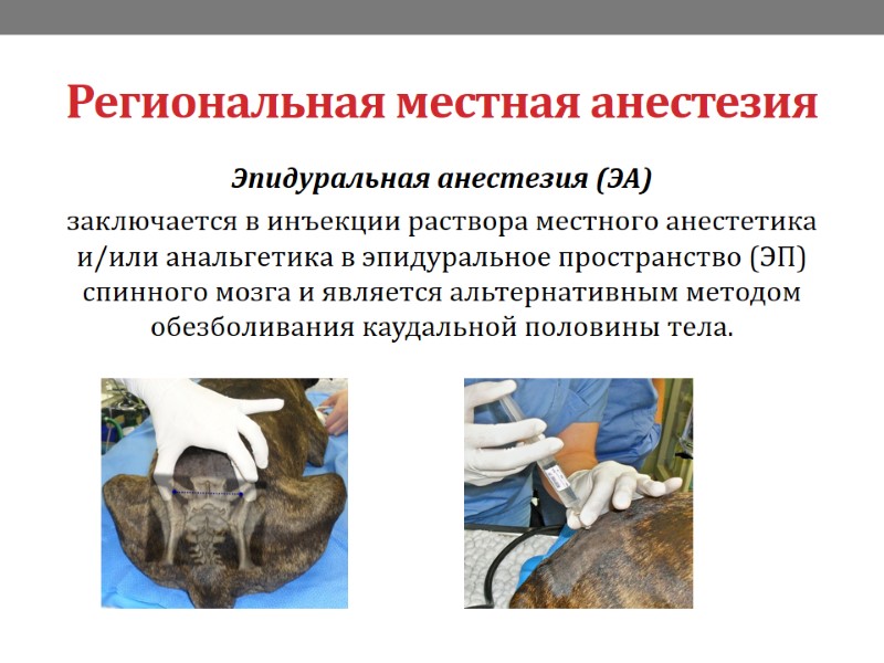 Региональная местная анестезия Эпидуральная анестезия (ЭА)  заключается в инъекции раствора местного анестетика и/или